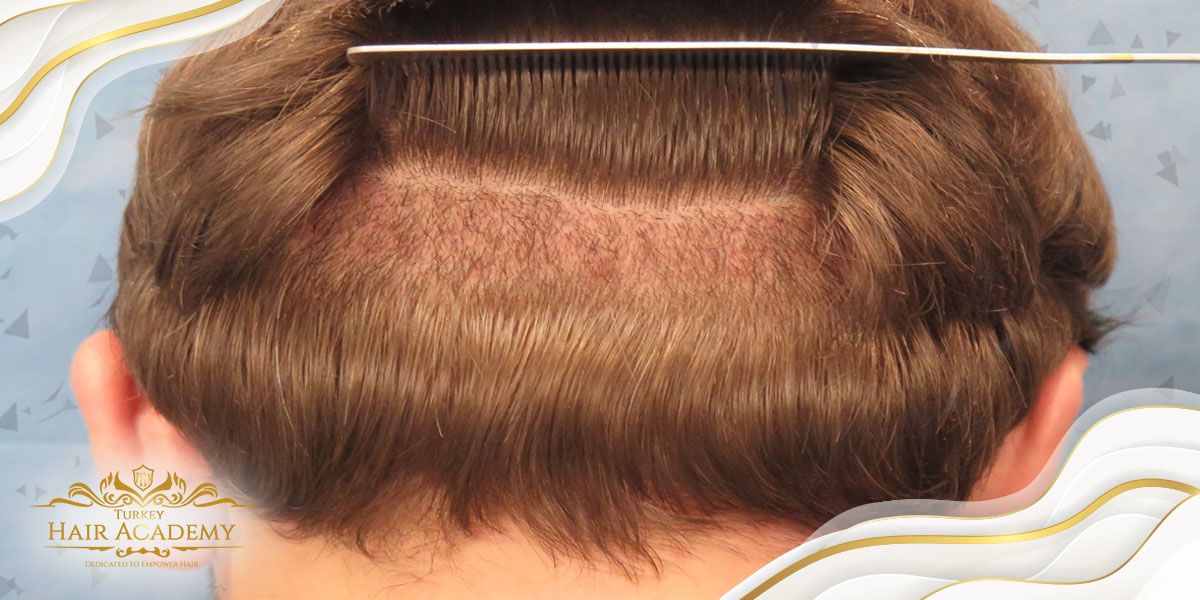 From Which Areas Are Roots Taken in Hair Transplantation? How efficient is it?