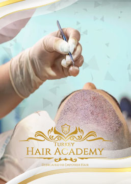 From Which Areas Are Roots Taken in Hair Transplantation? How Efficient is it?