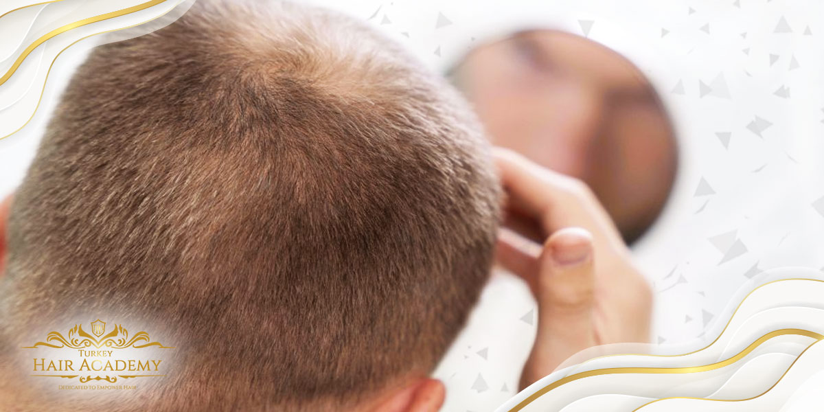 Is Hair Transplantation Permanent?