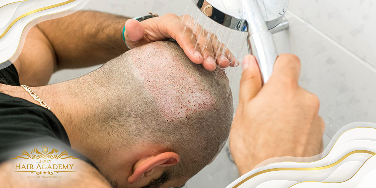 Tips for Hair Transplantation