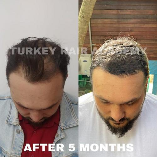 Hair Transplant in Turkey