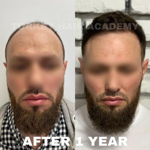 Hair Transplant in Turkey